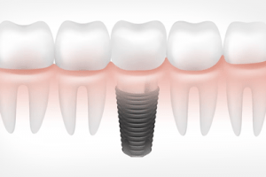 Что вас ждет после имплантации зубов