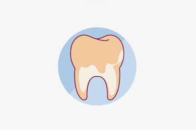 Зубной налет и его воздействие на полость рта