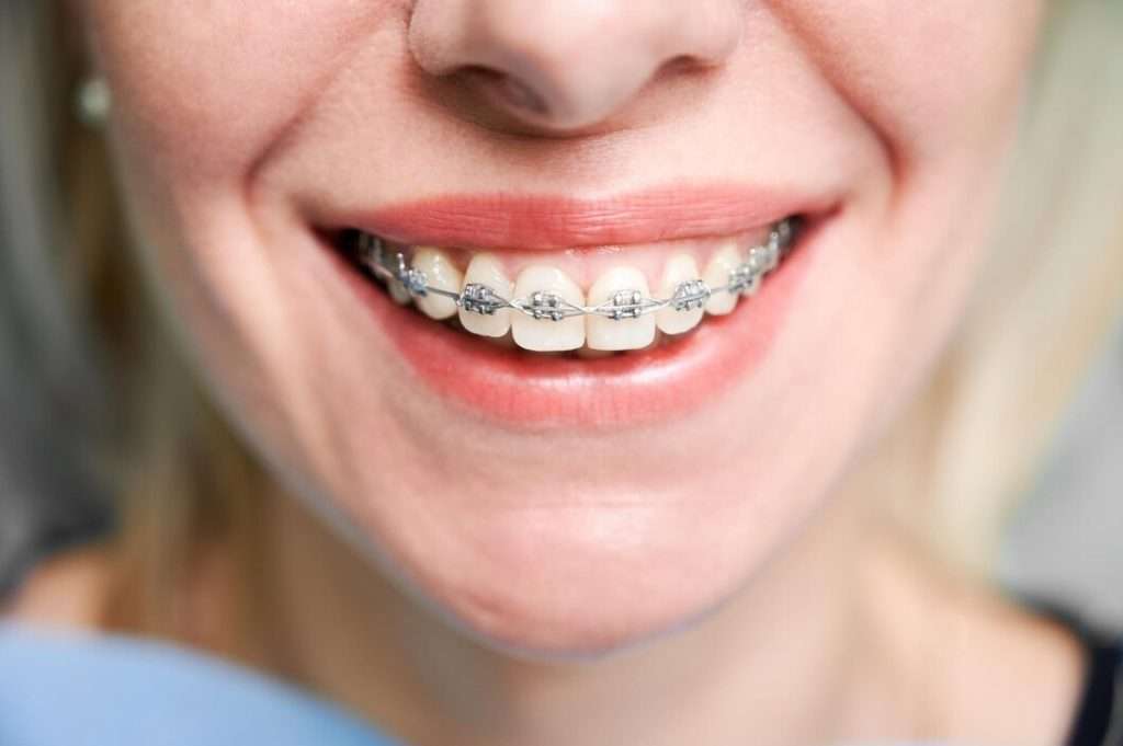 Советы по уходу за зубами для людей с брекетами